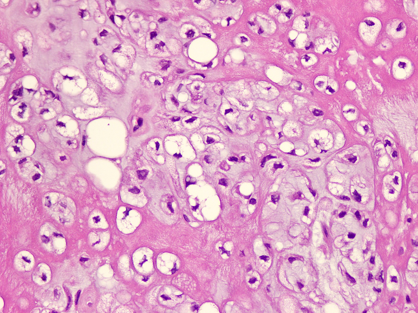 Multivacuolated lipoblasts