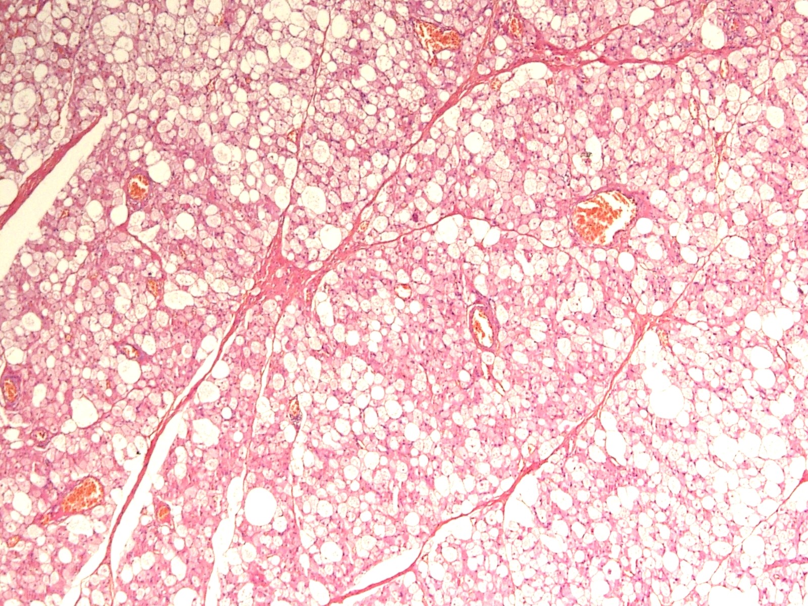 Sheets of brown cells and vasculature
