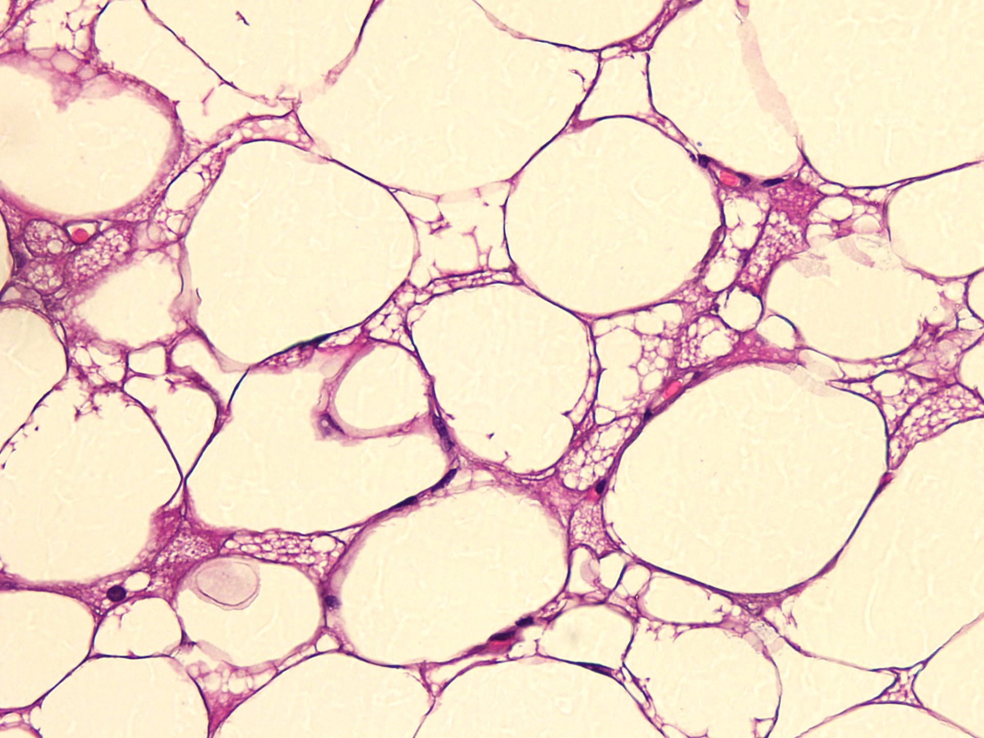 Univacuolated and granular eosinophilic cells