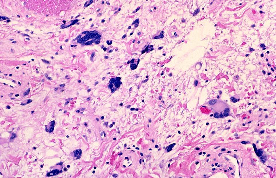 JCDR - Floret giant cells, Ropey collagen, Soft tissue neoplasm