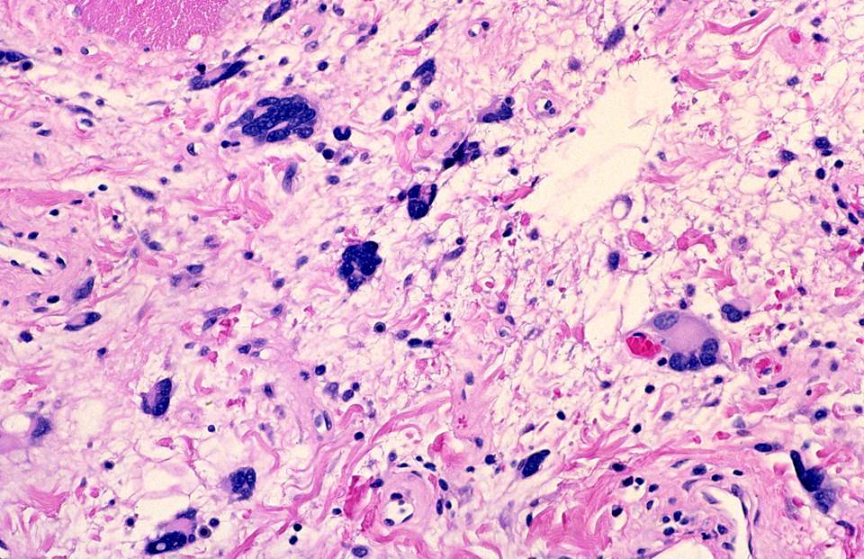 spindle cells and ropey collagen- found in spindle cell lipomas