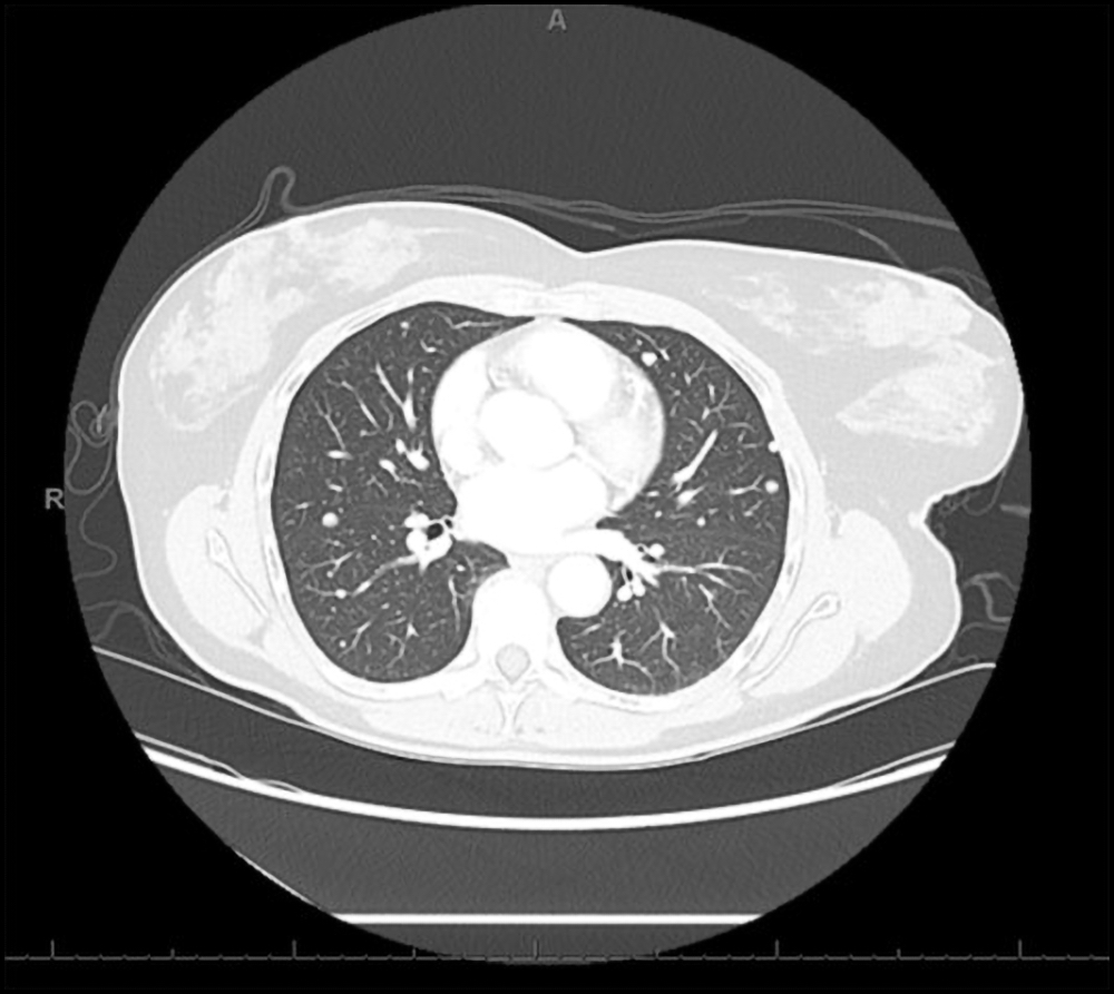 Pulmonary metastases