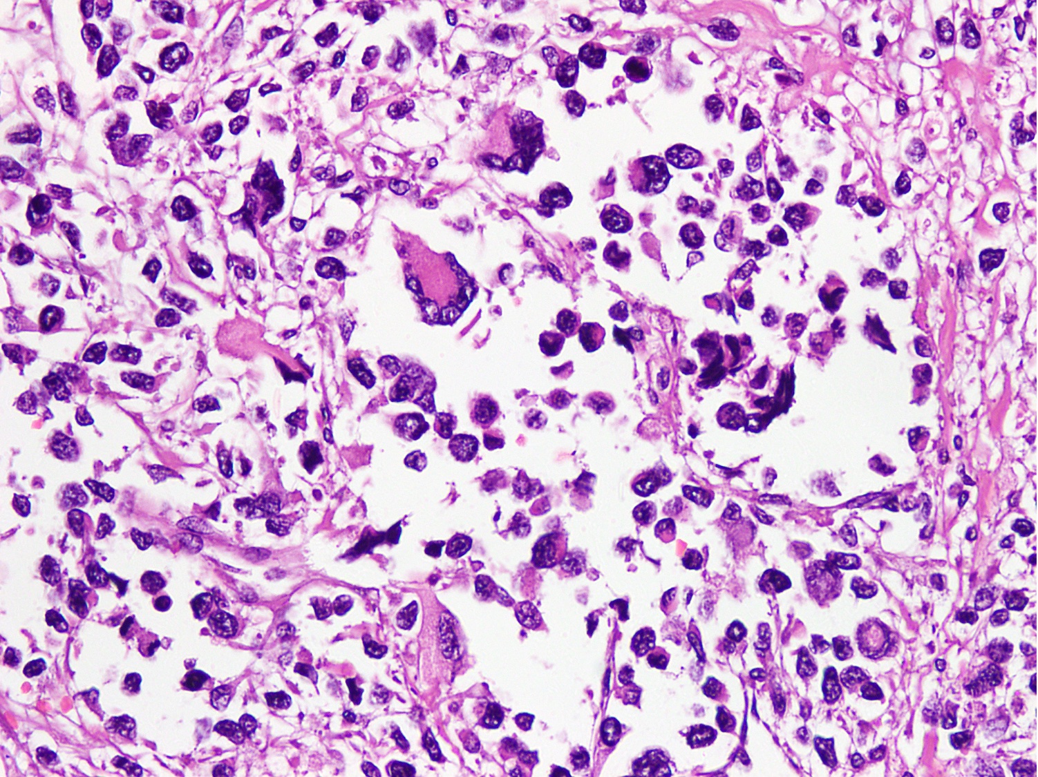Wreath-like multinucleated giant cells