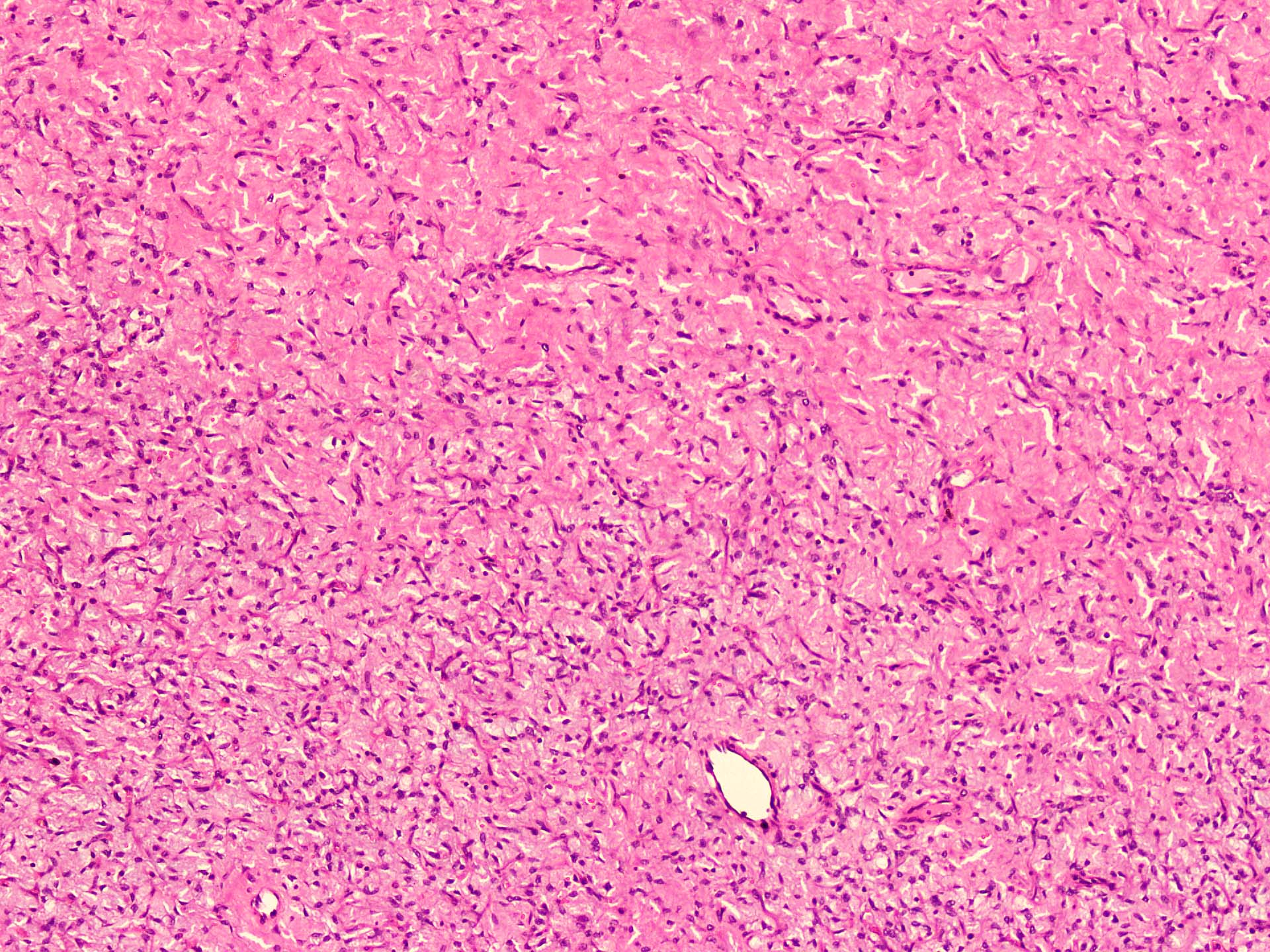 Spindle cell neoplasm with occasional ectatic vessels