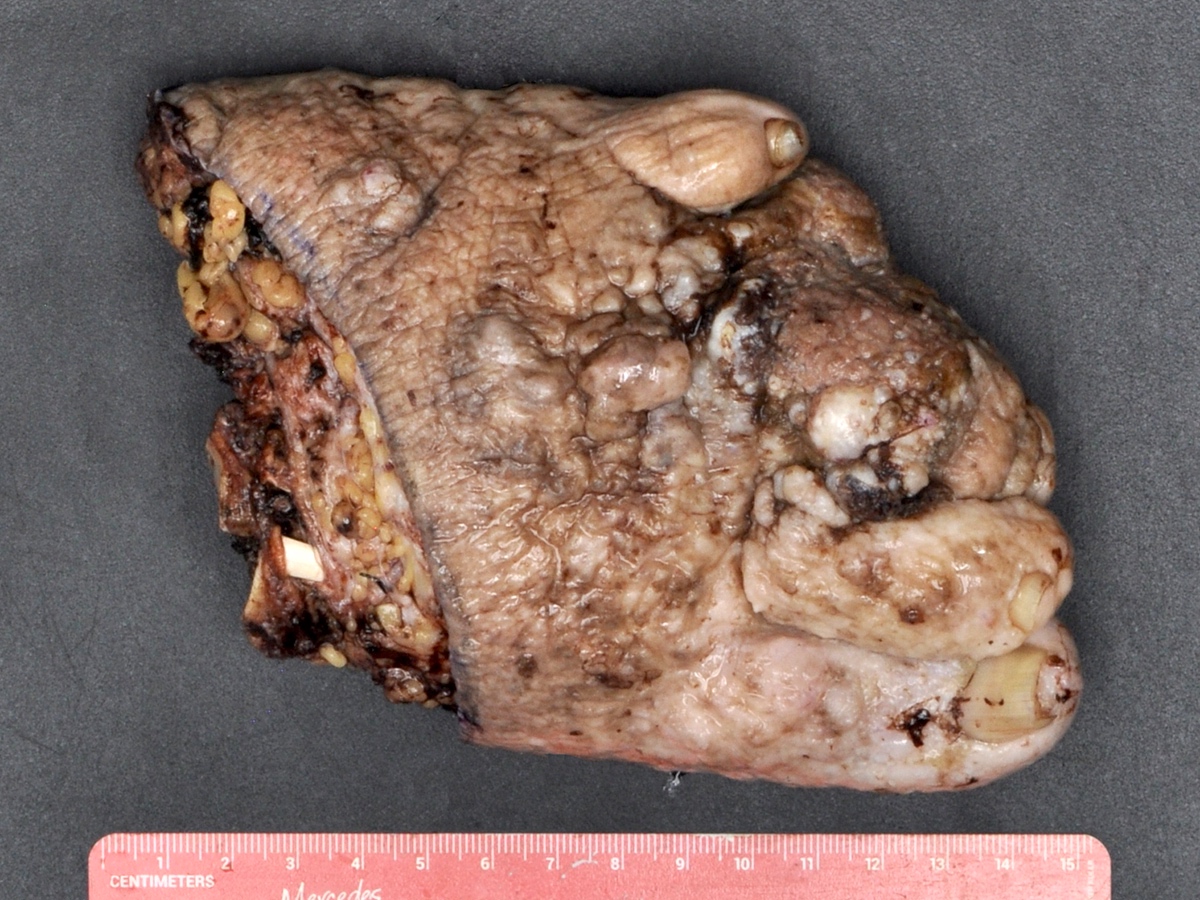 Angiosarcoma on the foot