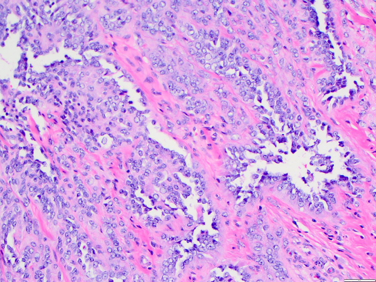 Atypical endothelial cells