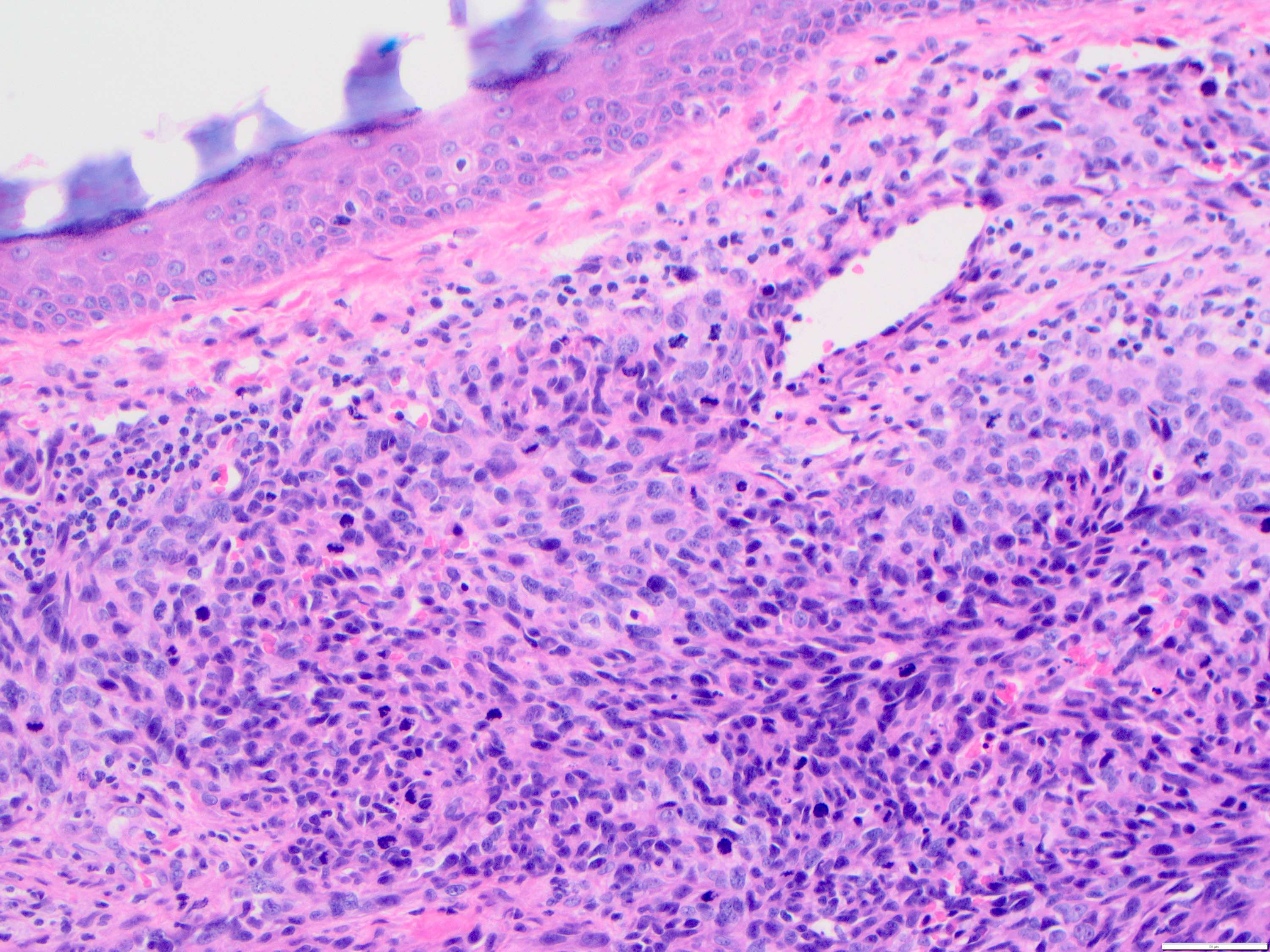 Solid pattern of angiosarcoma