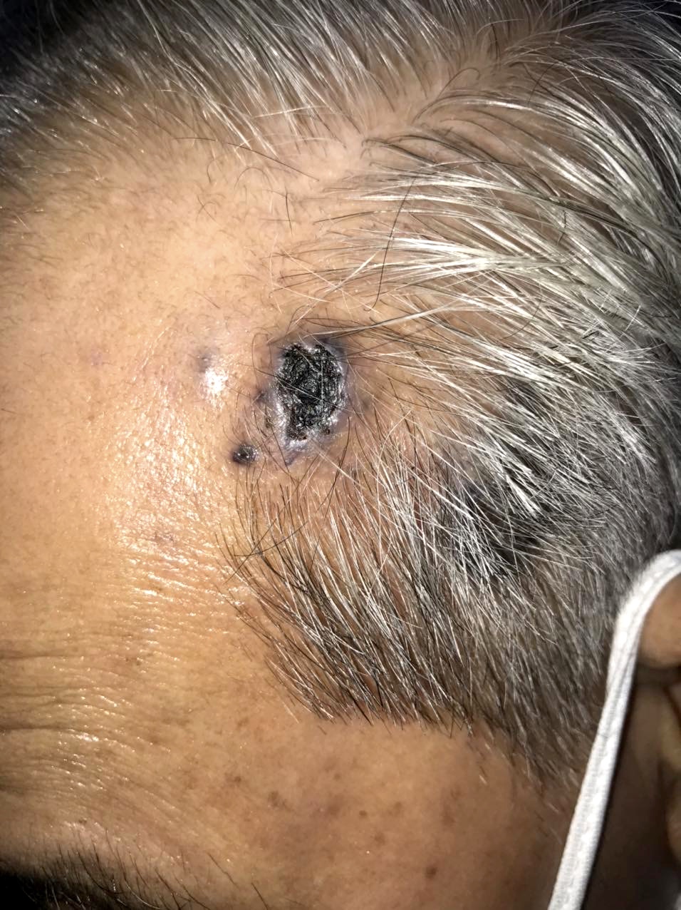 Angiosarcoma on the forehead