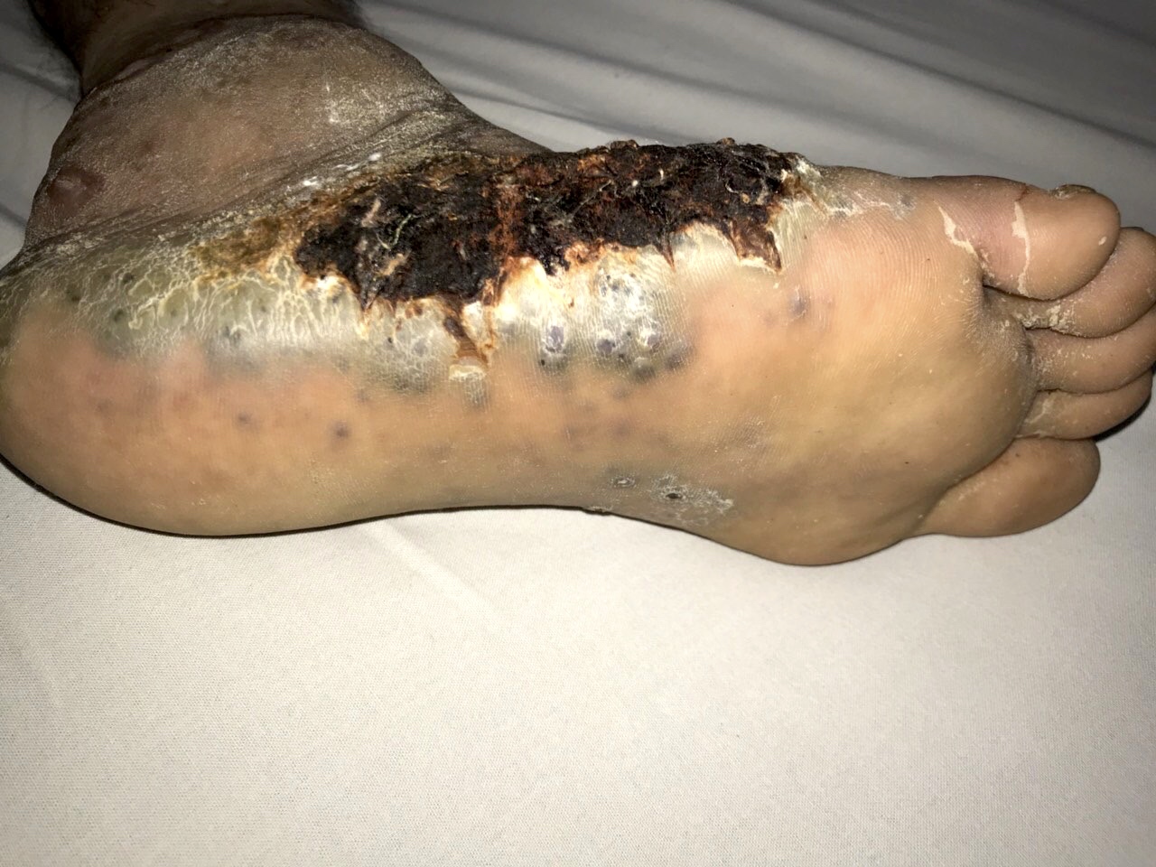 Angiosarcoma on the foot