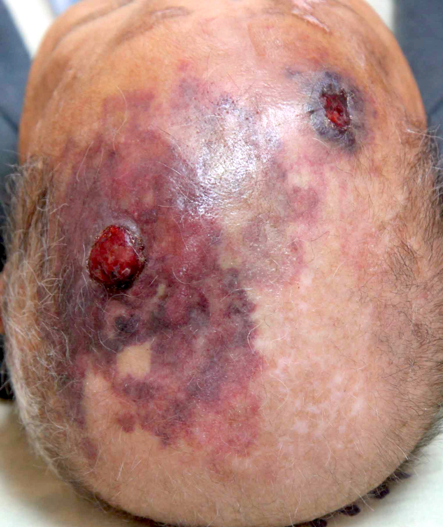 Angiosarcoma on the scalp