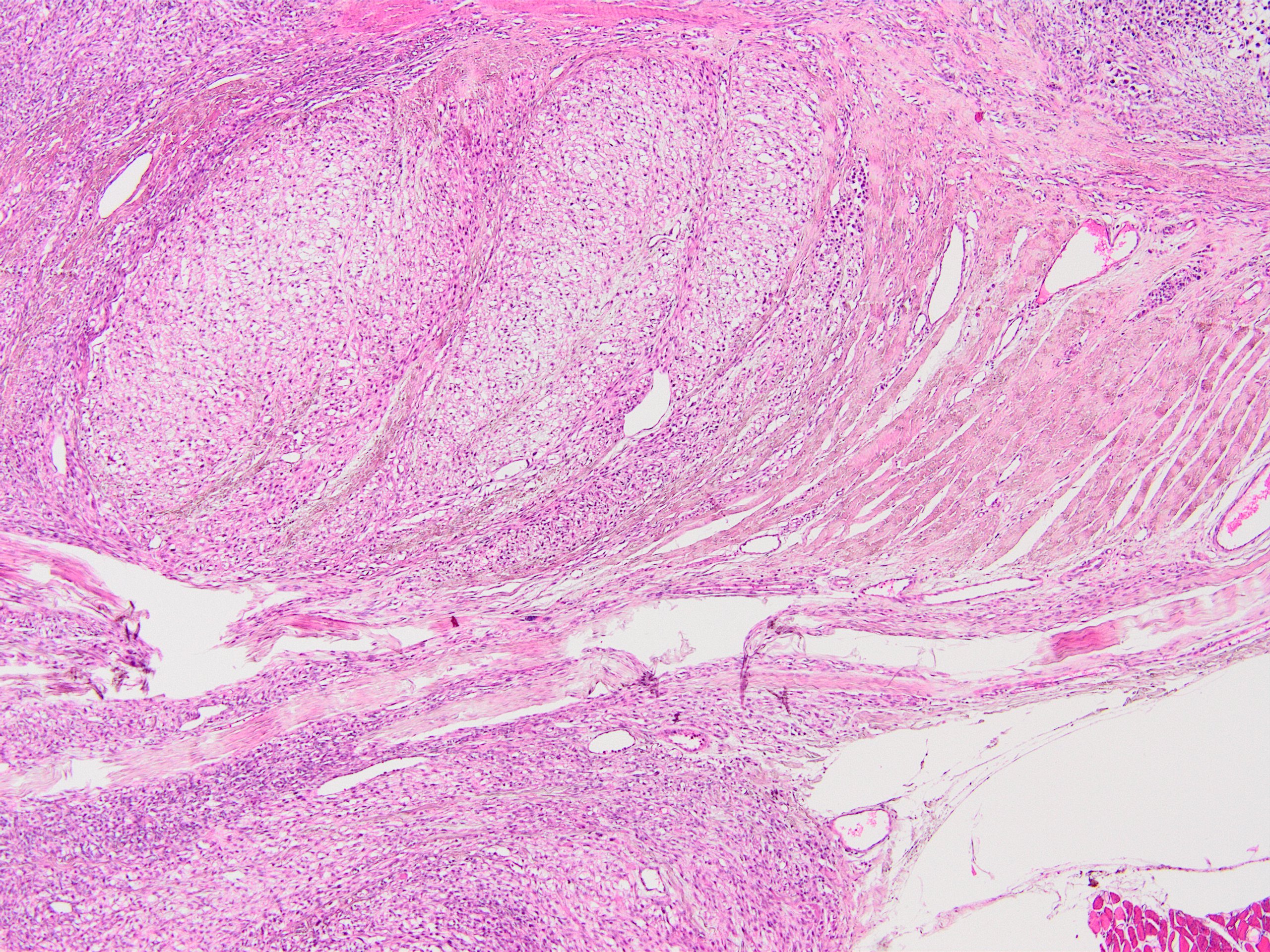 Tumor adjacent to tendon and aponeurosis