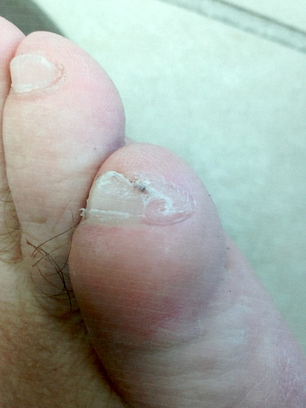 Swelling over the toe