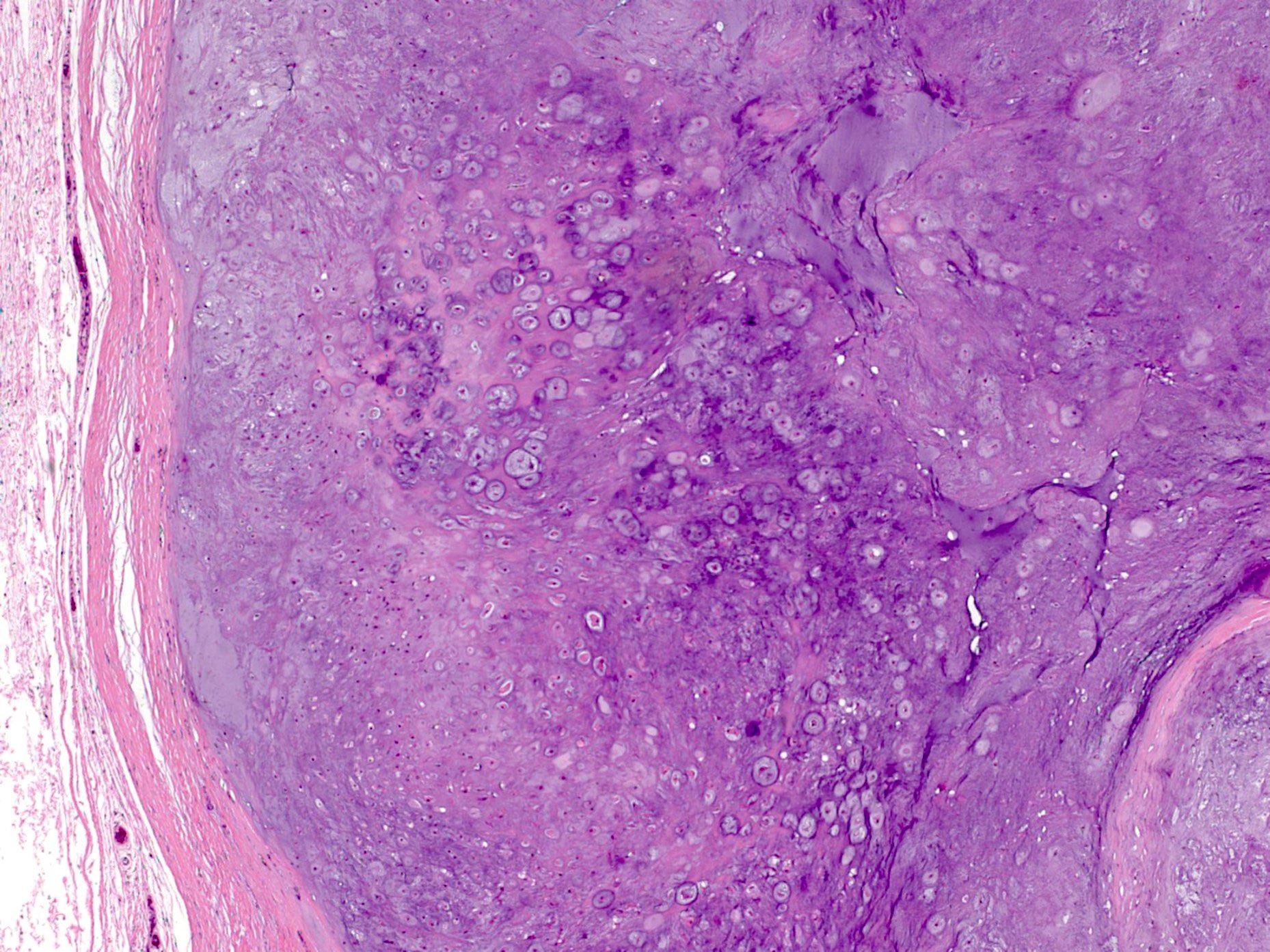 Fibrous pseudocapsule