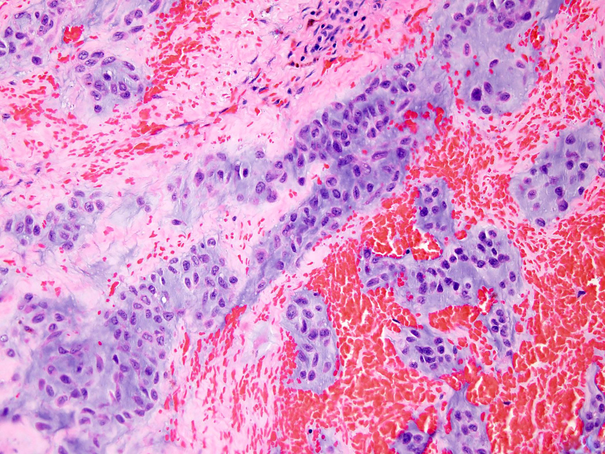 Gyerekkori tumorok. Dr. Hal{sz Judit PhD - PDF Free Download