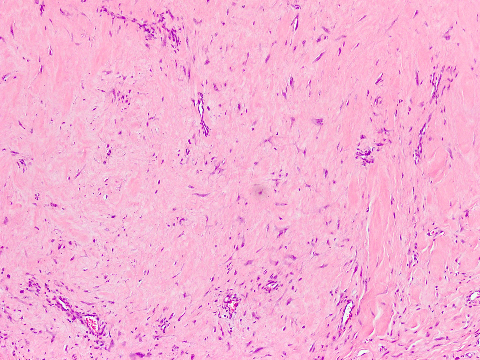 Paucicellular lesion with collagenous stroma