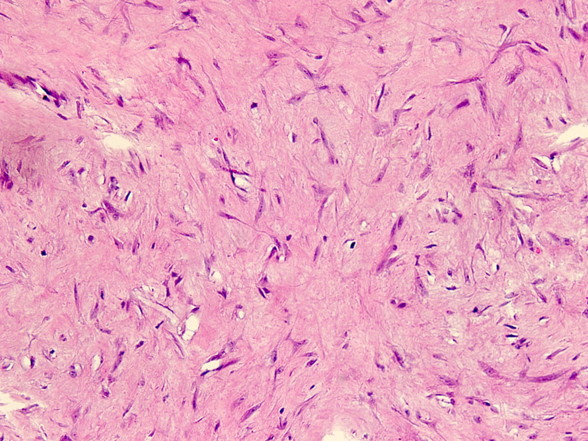 Spindle cell proliferation