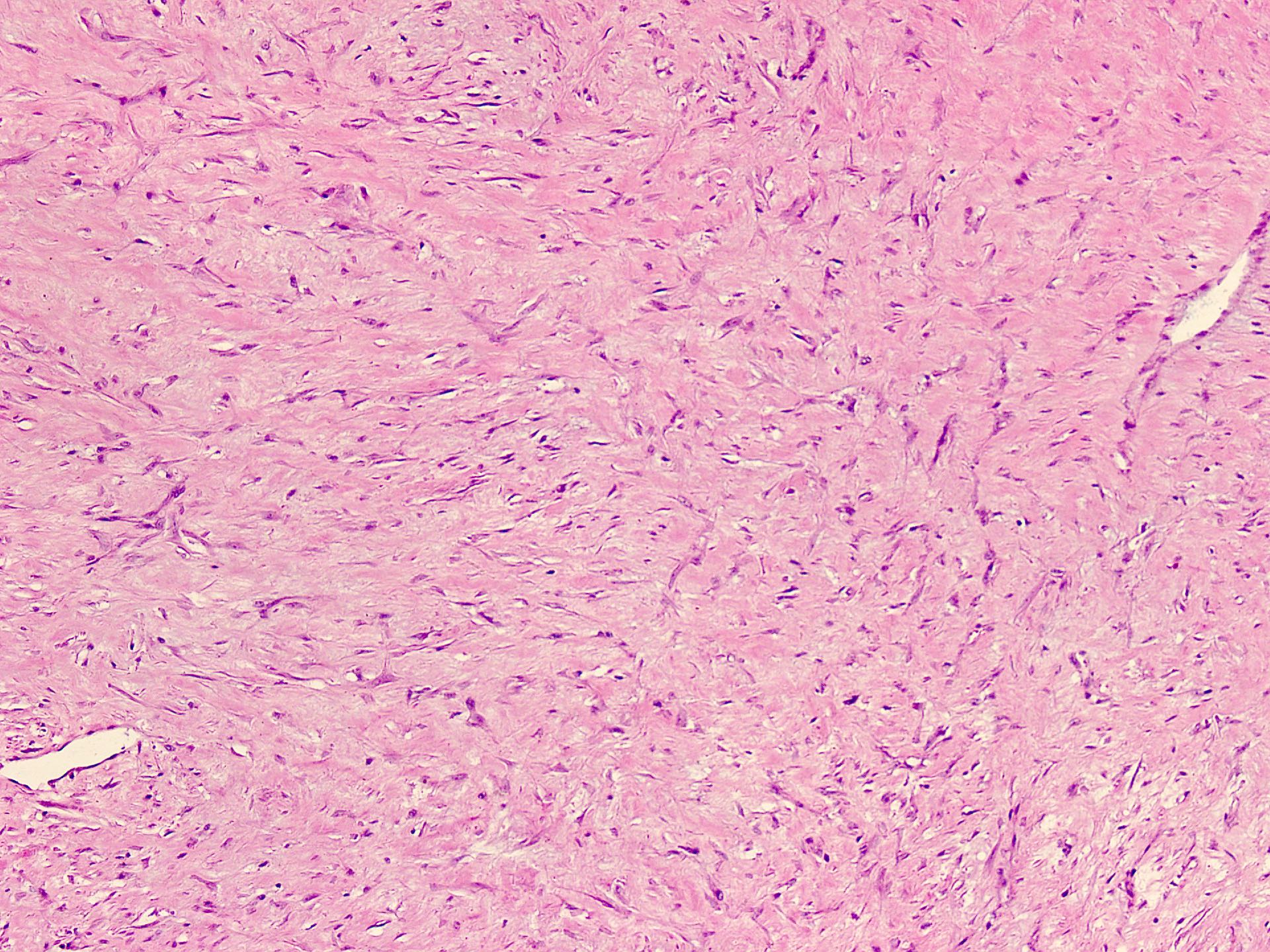 Spindle cell lesion