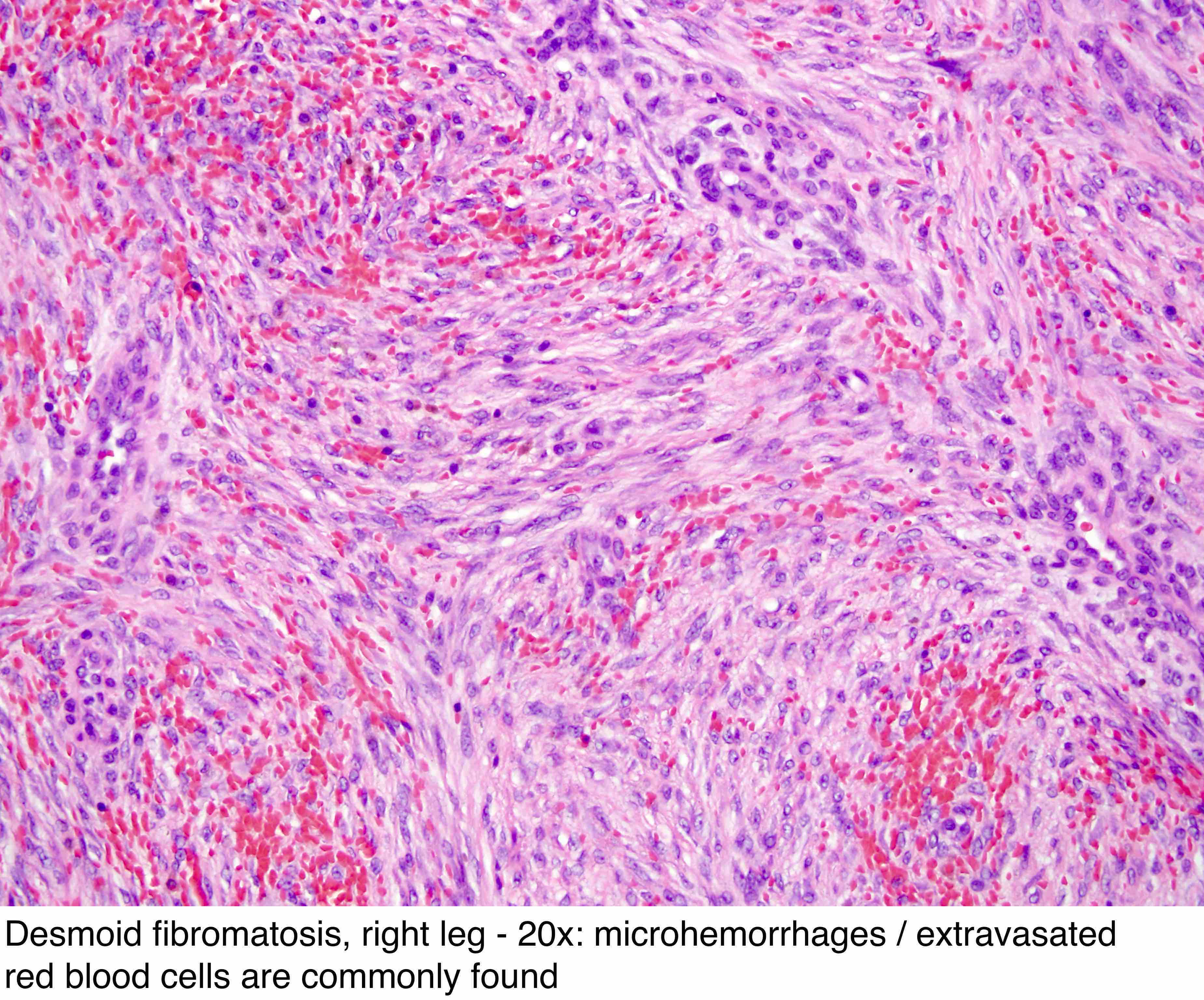 Plantar Fibromatosis Pathology Outlines