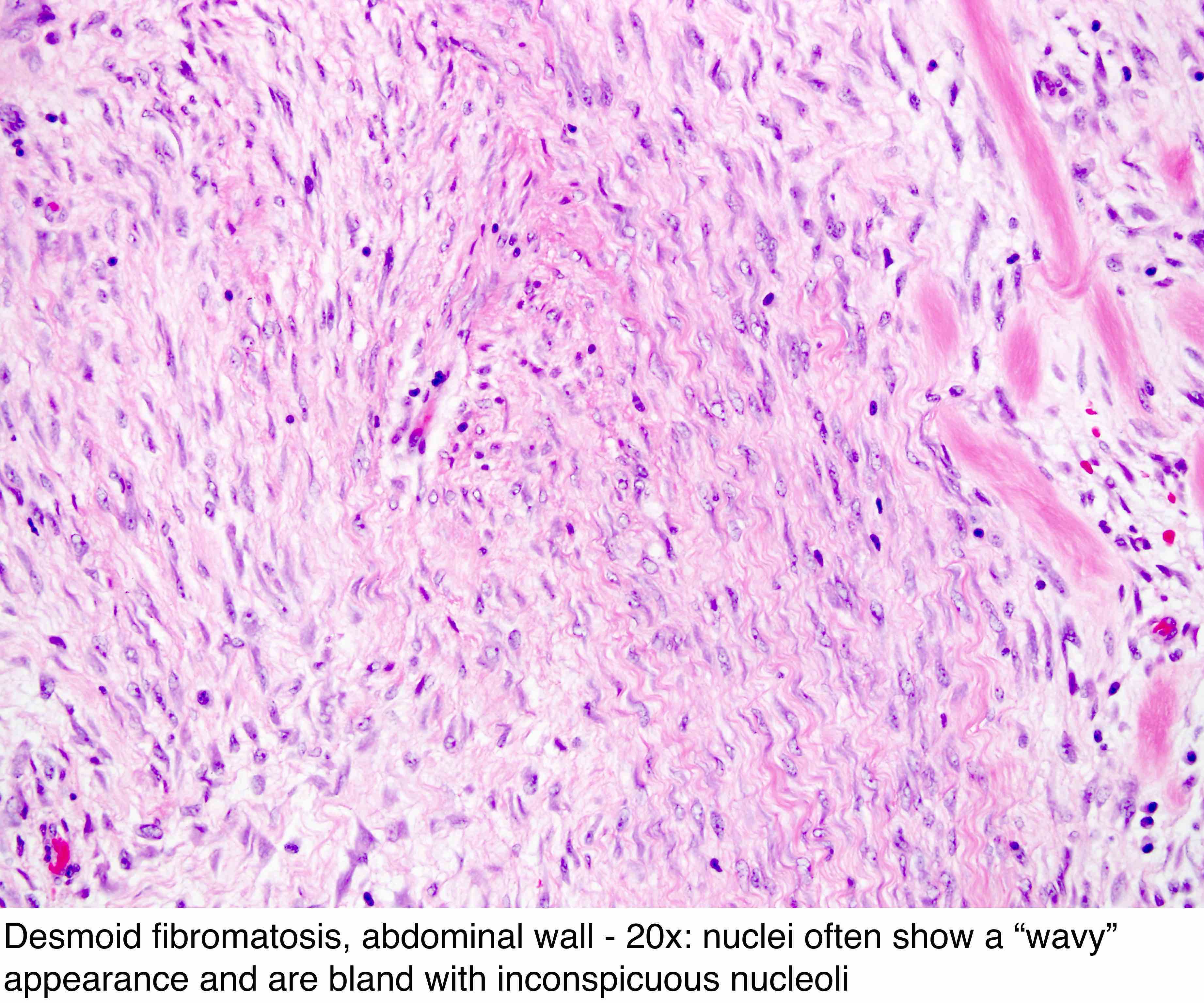 Plantar Fibromatosis Pathology Outlines
