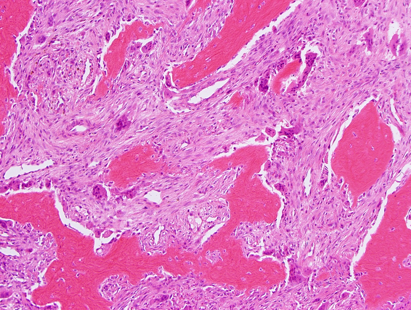 JCDR - Floret giant cells, Ropey collagen, Soft tissue neoplasm