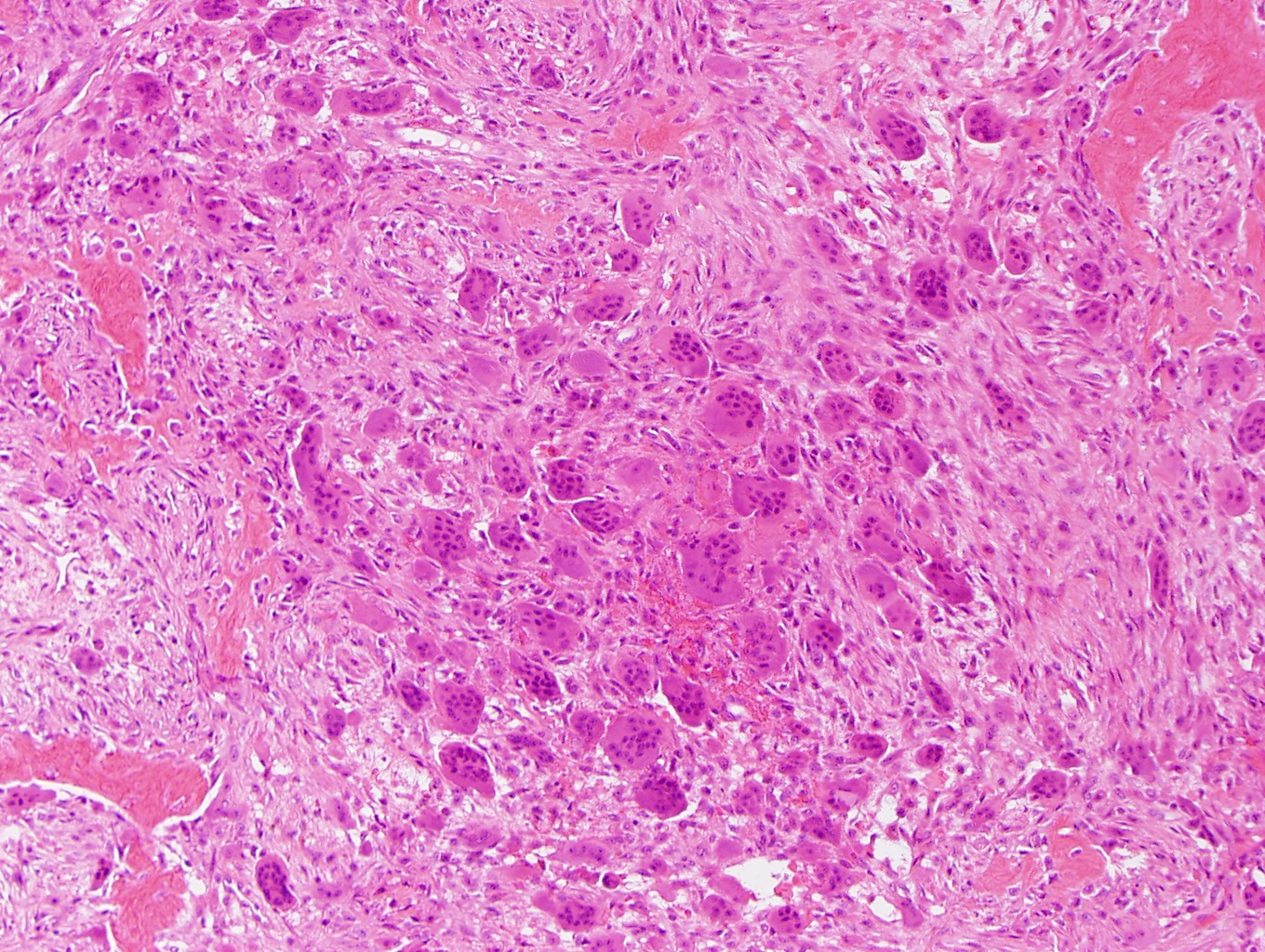 JCDR - Floret giant cells, Ropey collagen, Soft tissue neoplasm