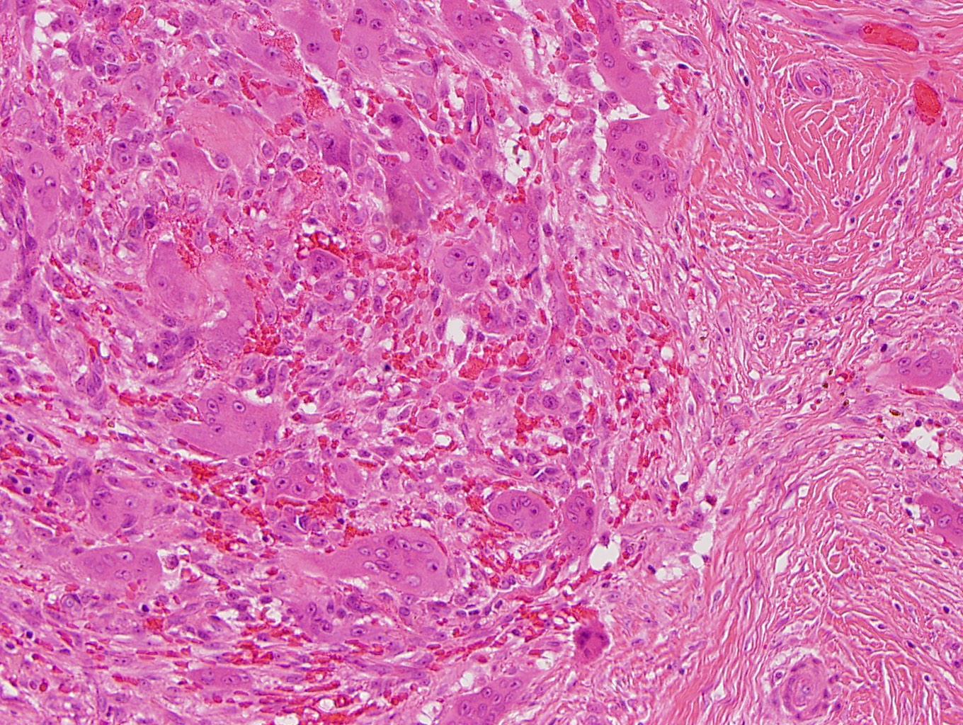 JCDR - Floret giant cells, Ropey collagen, Soft tissue neoplasm