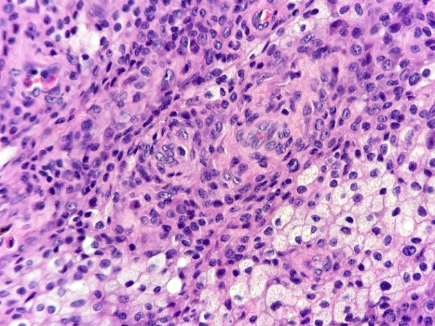Foamy histiocytes (xanthoma cells)