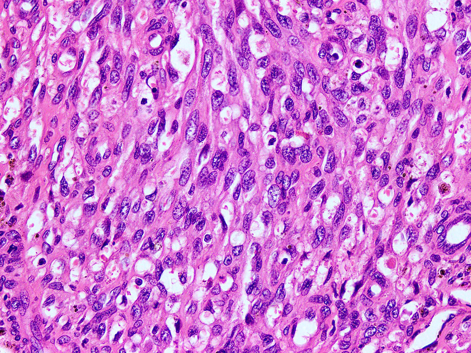Spindle cell hemangioma