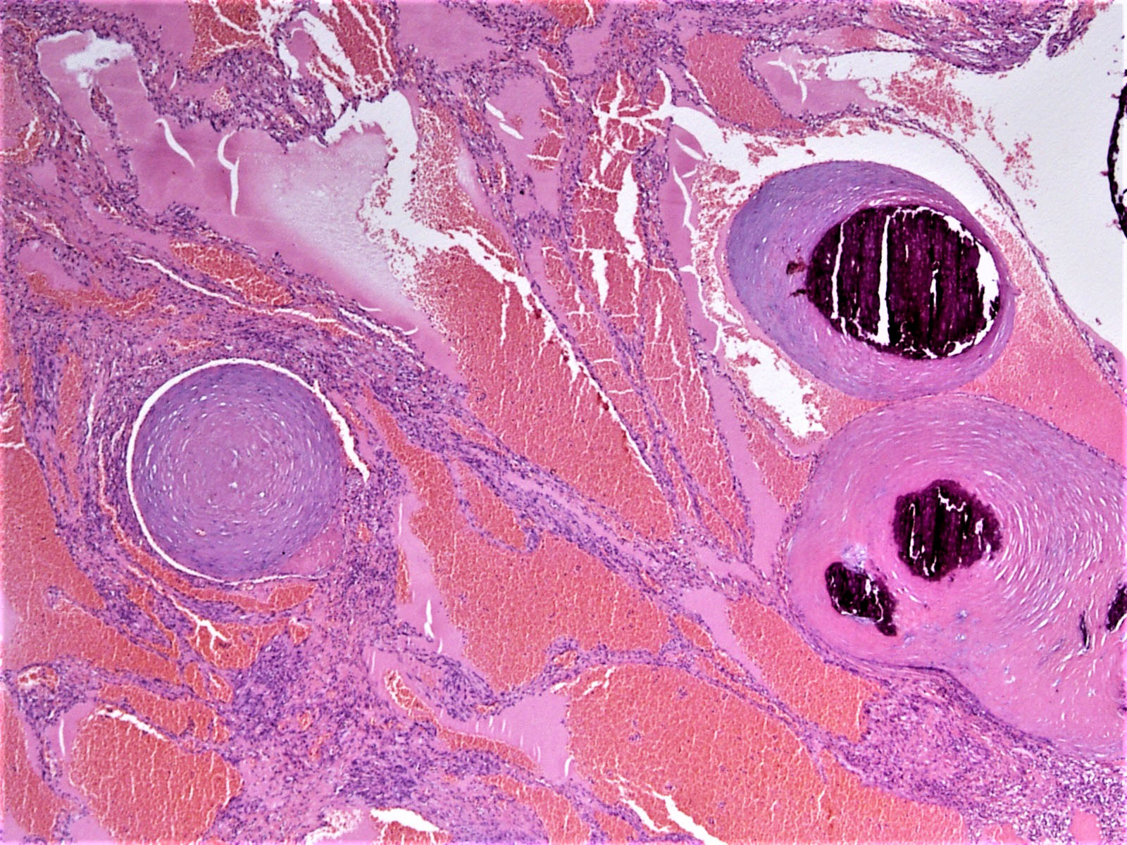 Phleboliths in spindle cell hemangioma