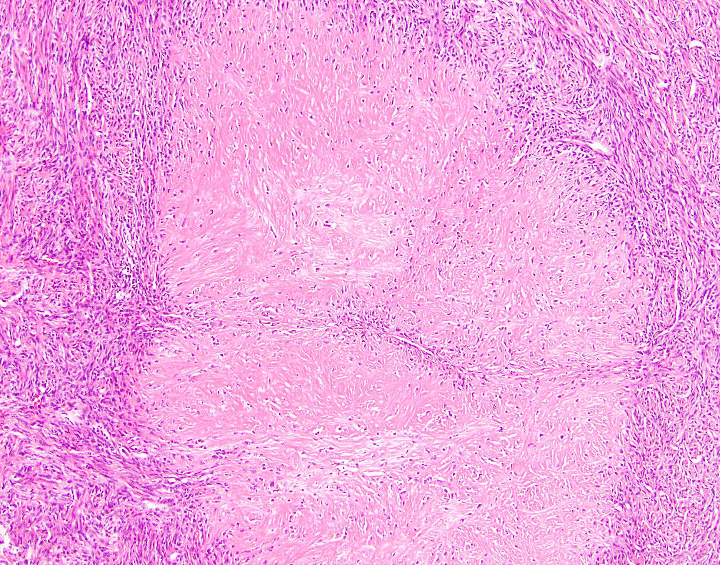 Low grade fibromyxoid sarcoma with giant rosettes