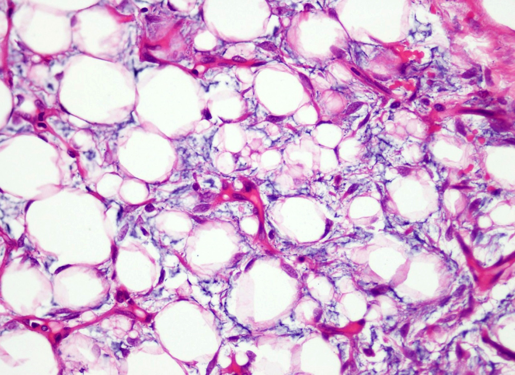 Lipoblasts and mesenchymal cells