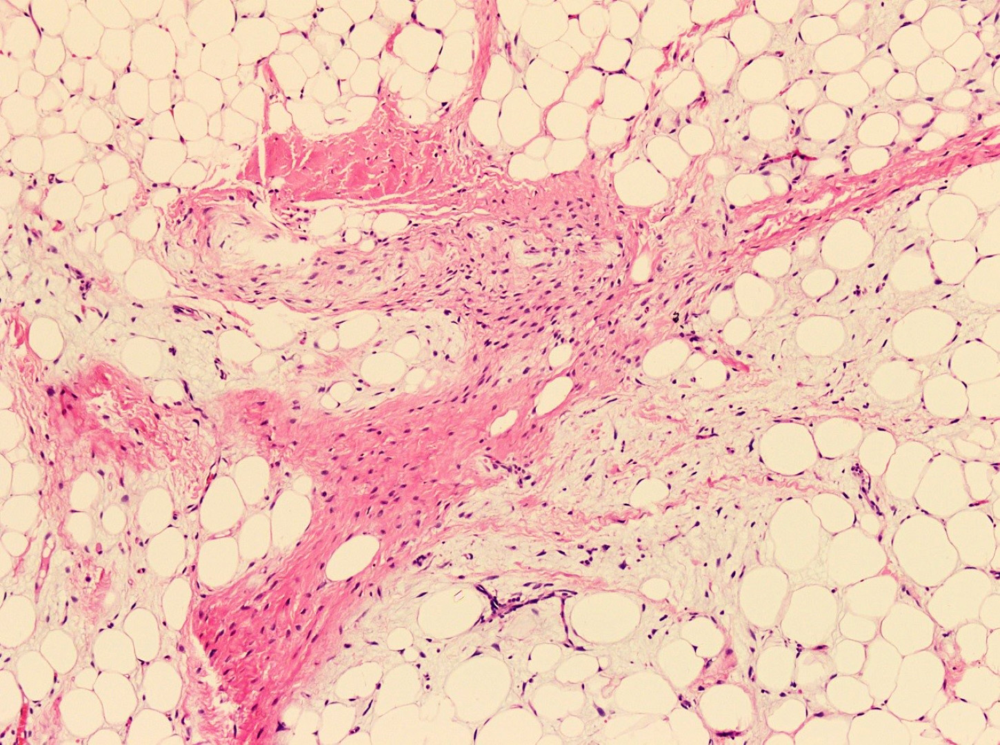 Primitive mesenchymal cells