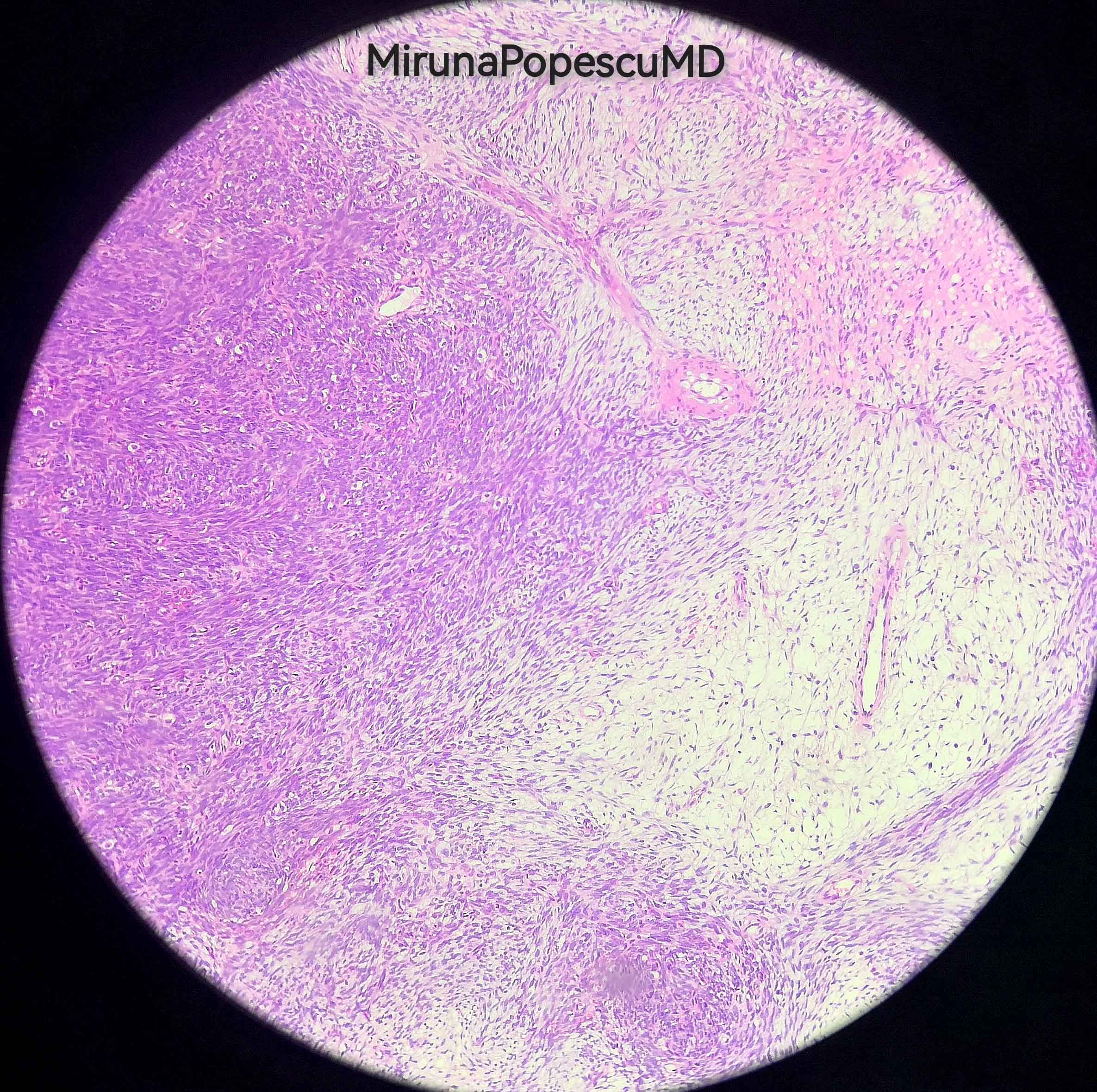 Malignant peripheral nerve sheath tumor (MPNST)