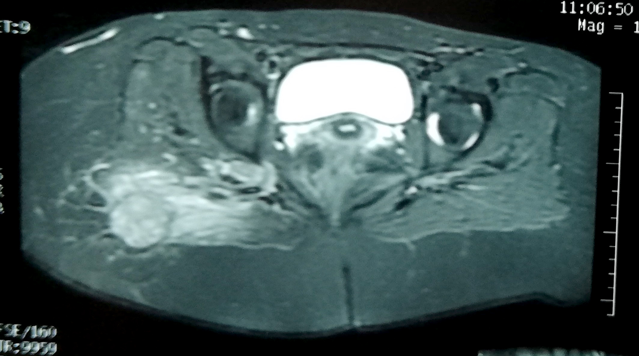 MRI buttock for soft tissue mass