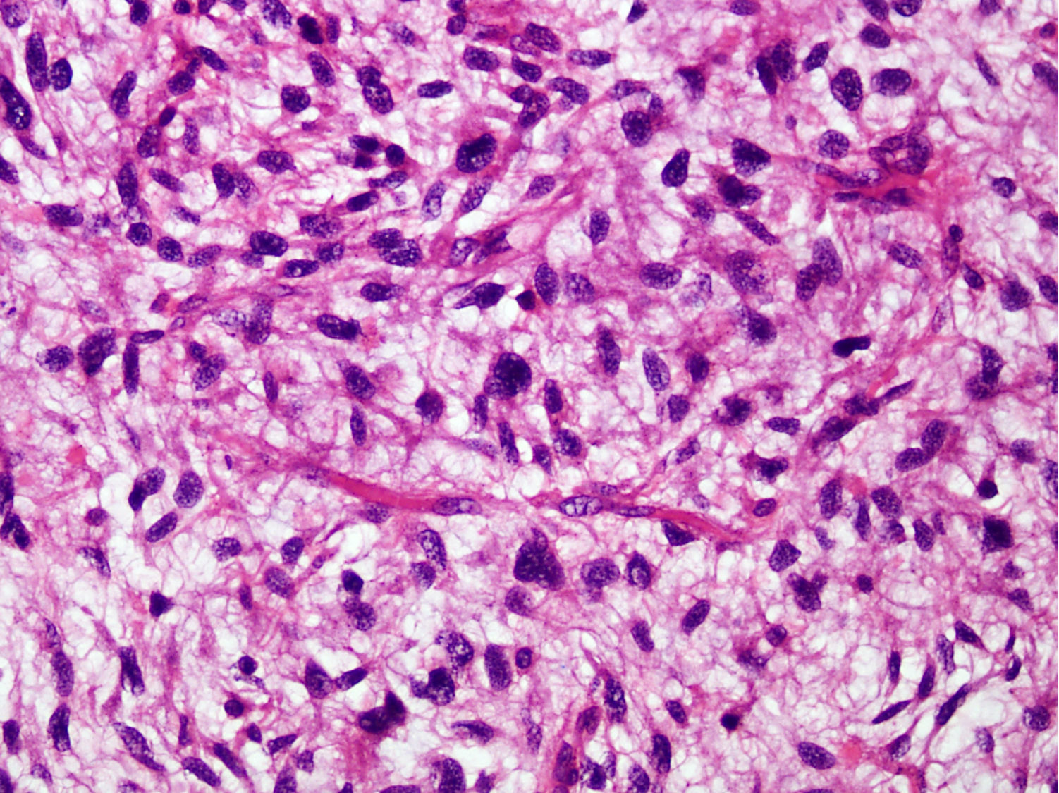 Hyperchromatic atypical spindle cells