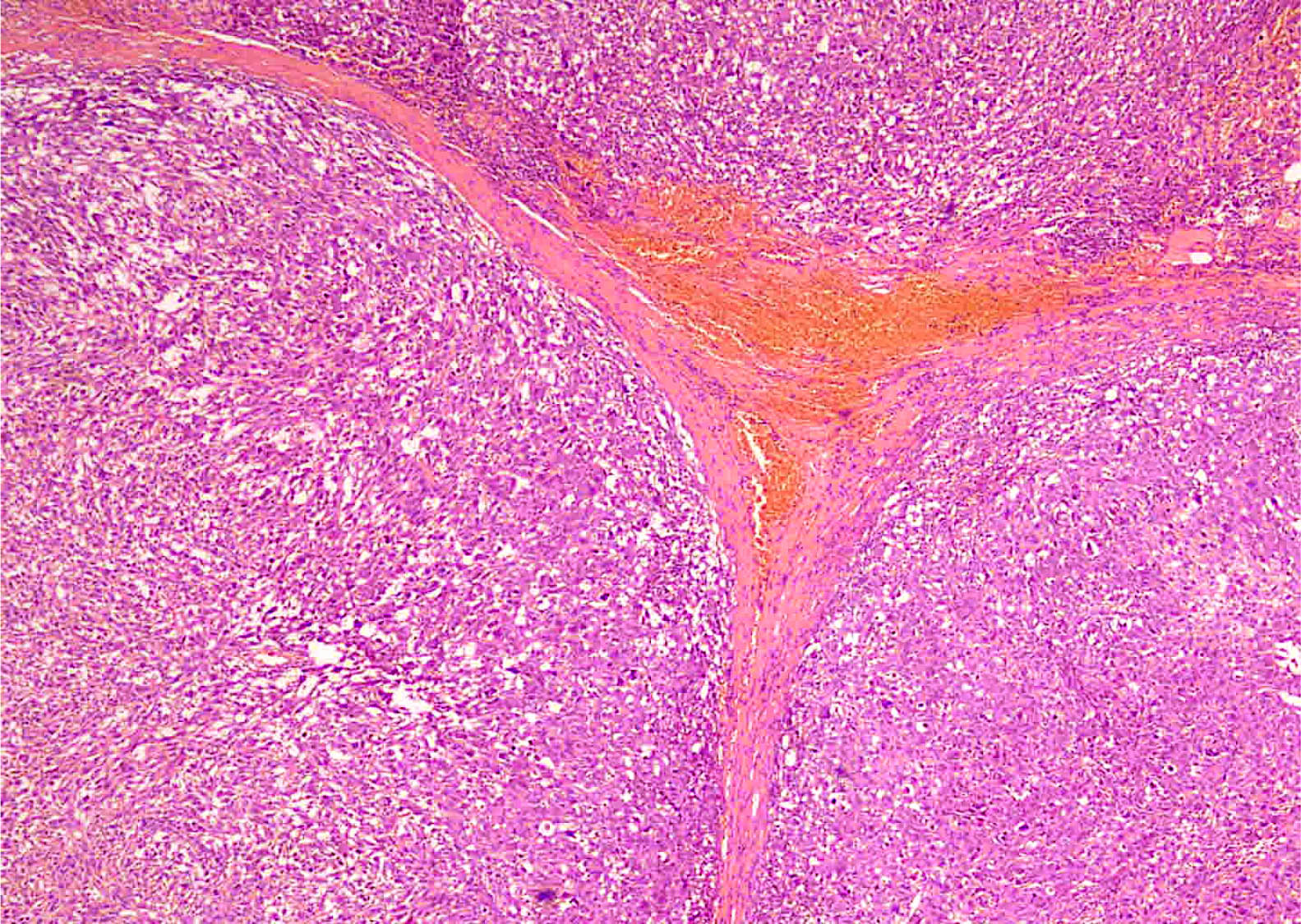 Lobulated cellular tumor