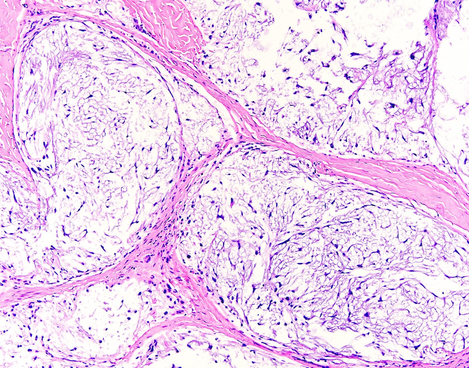 Pathology Outlines - Dermal nerve sheath myxoma