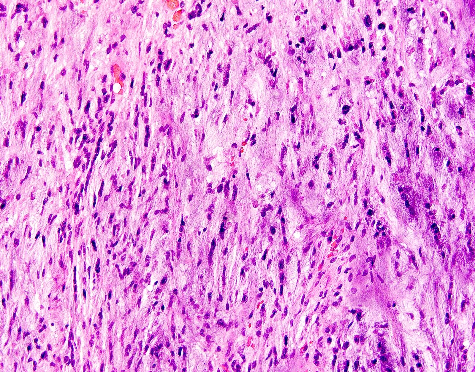 Pathology Outlines - Dermal nerve sheath myxoma