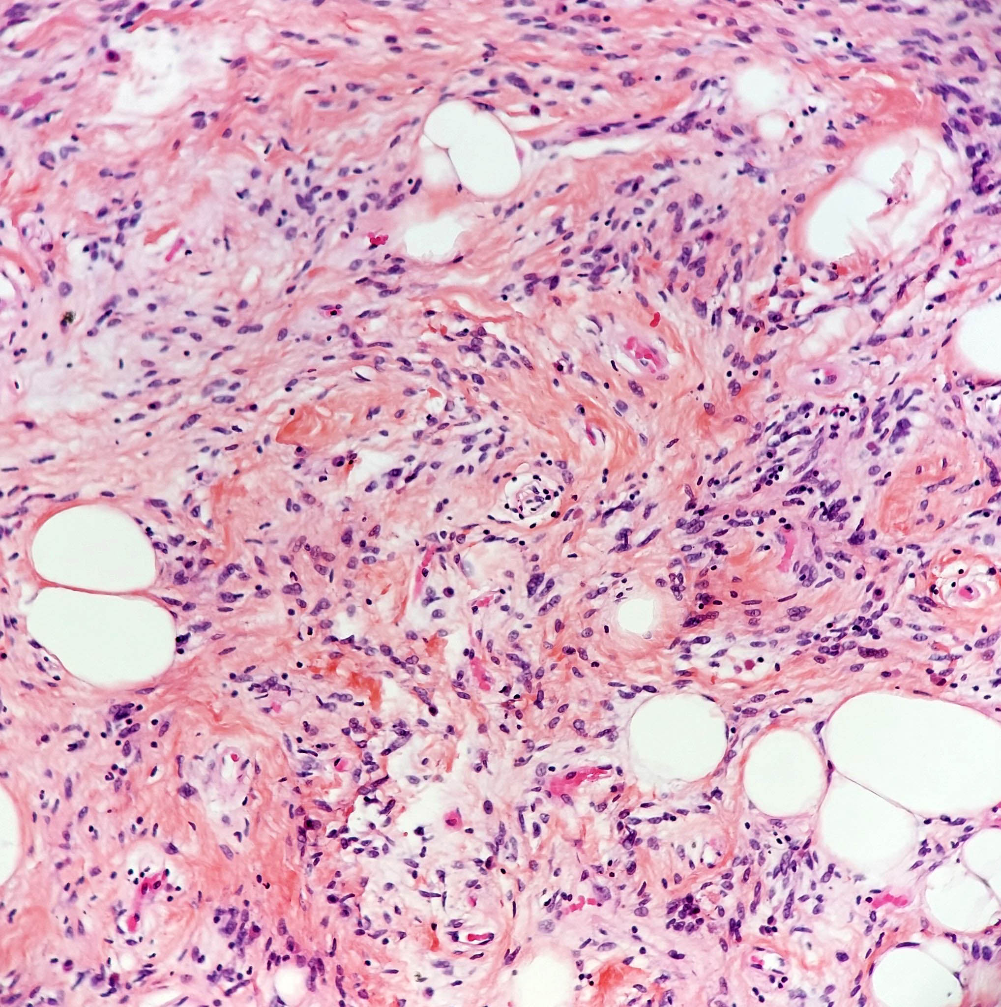 Spindle cell / pleomorphic lipoma