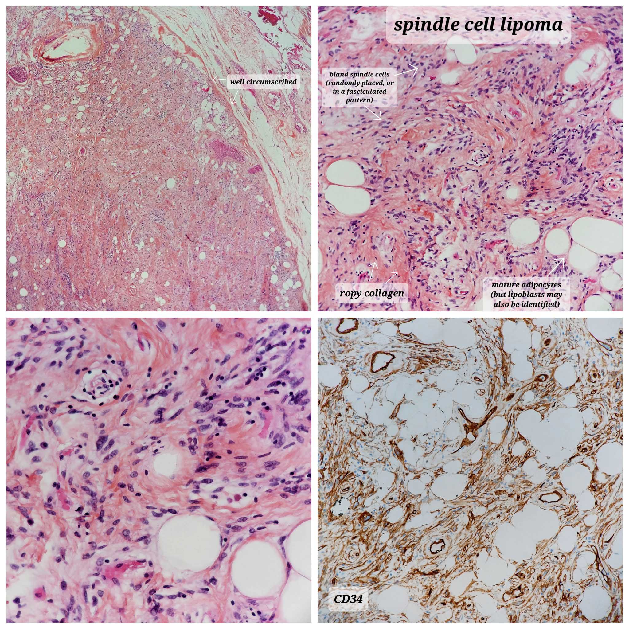 Spindle cell / pleomorphic lipoma