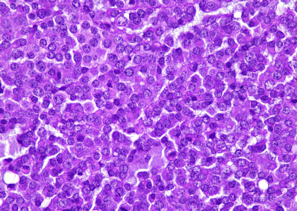 Rhabdoid cells