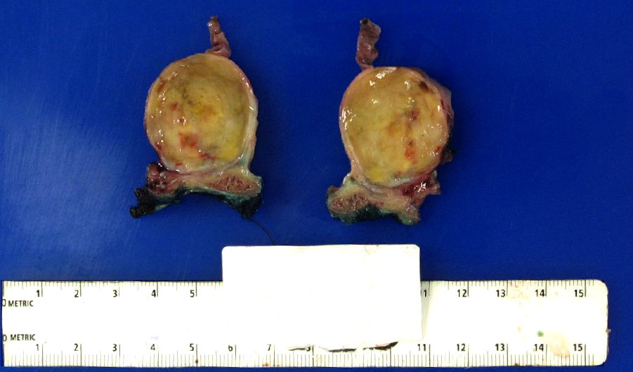Lesion associated with intercostal nerve