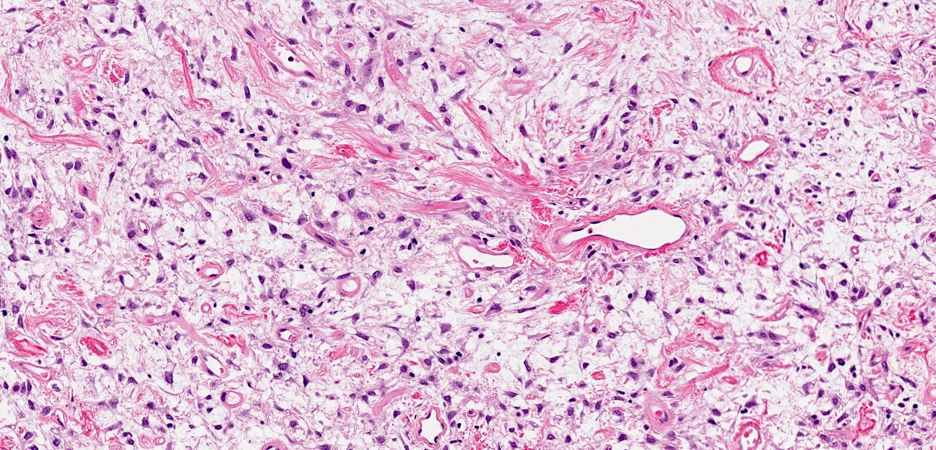 Myxoid solitary fibrous tumor