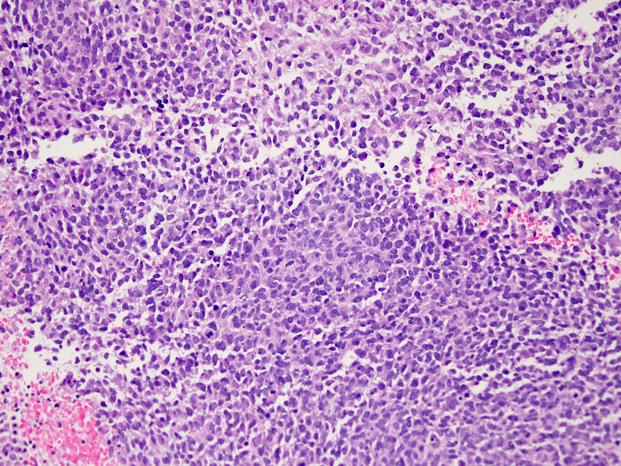 Sarcoma with BCOR genetic alterations