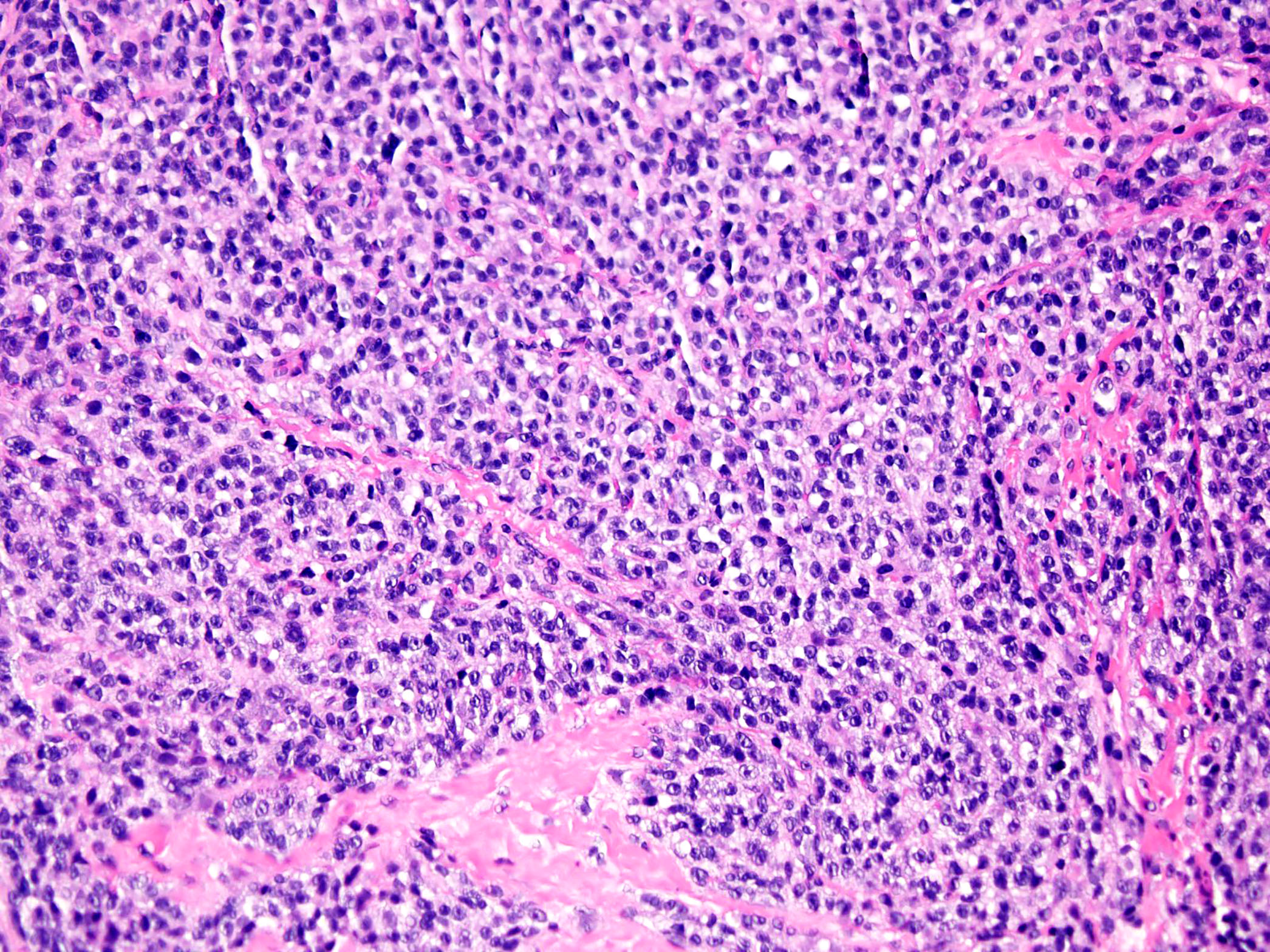 Clear cell sarcoma