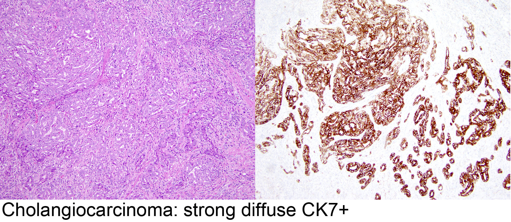 prostate adenocarcinoma ck7 positive