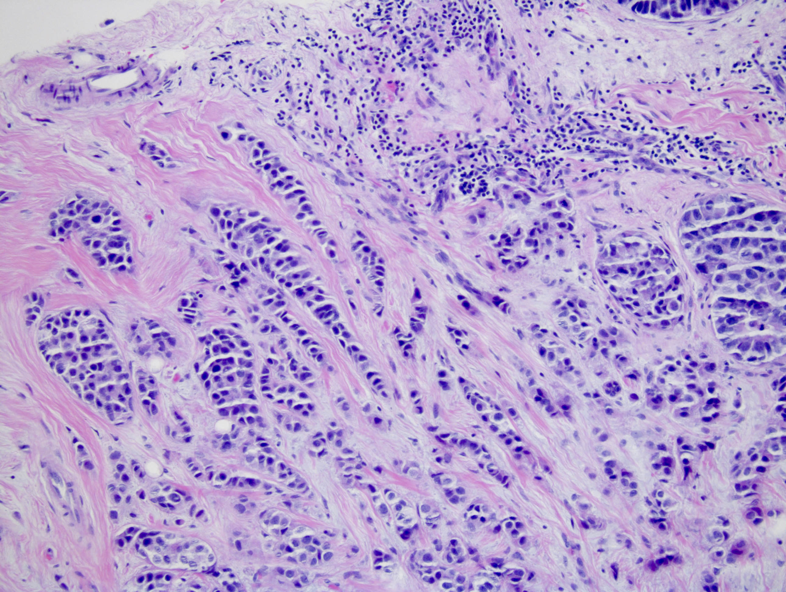Invasive ductal carcinoma breast