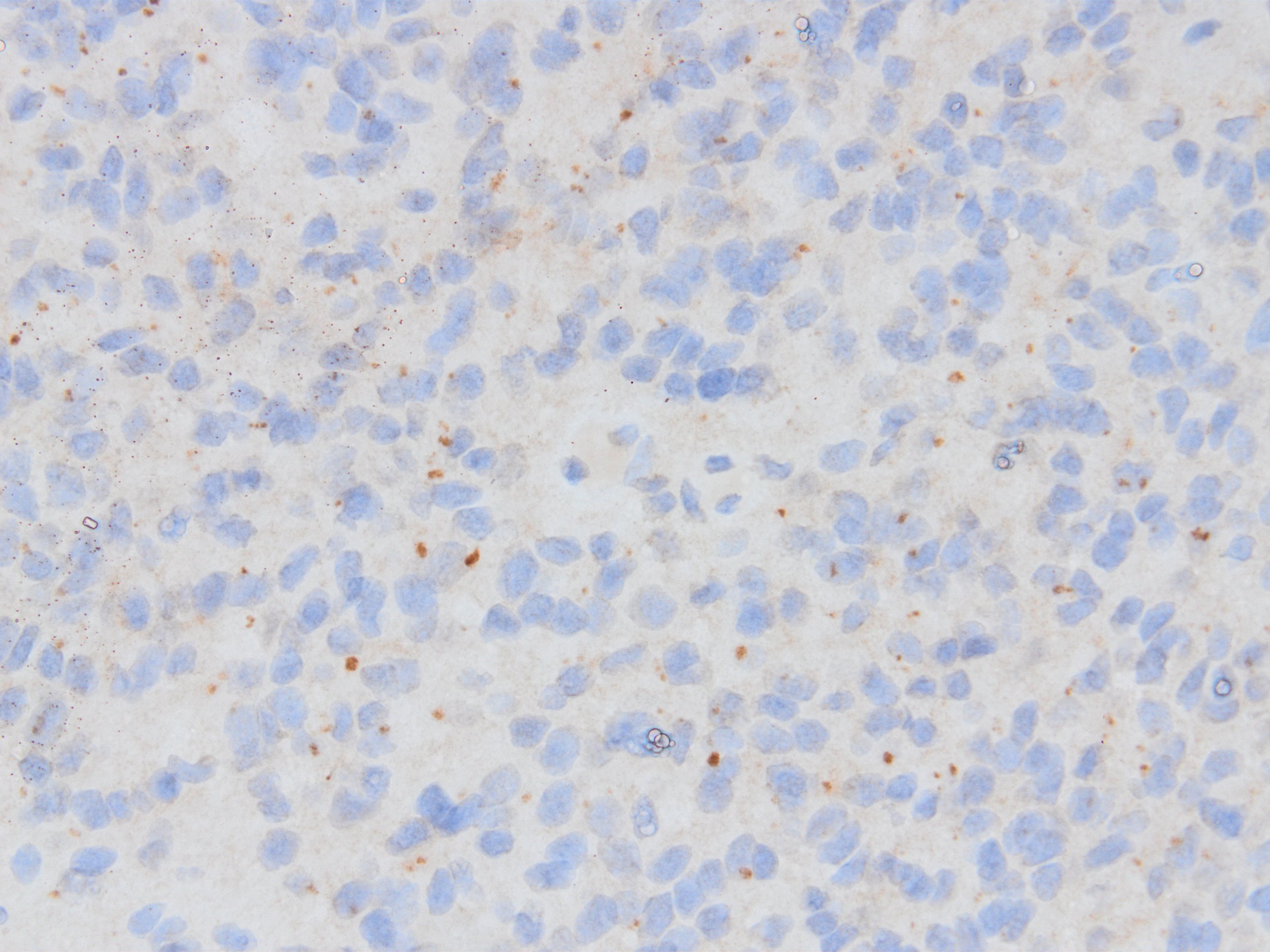 D2-40 expression in ependymoma