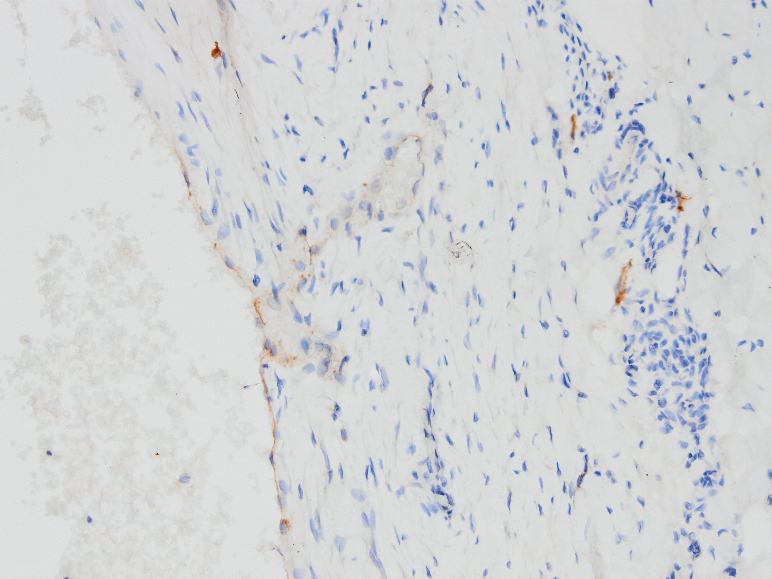 D2-40 expression proves lymphatic malformation