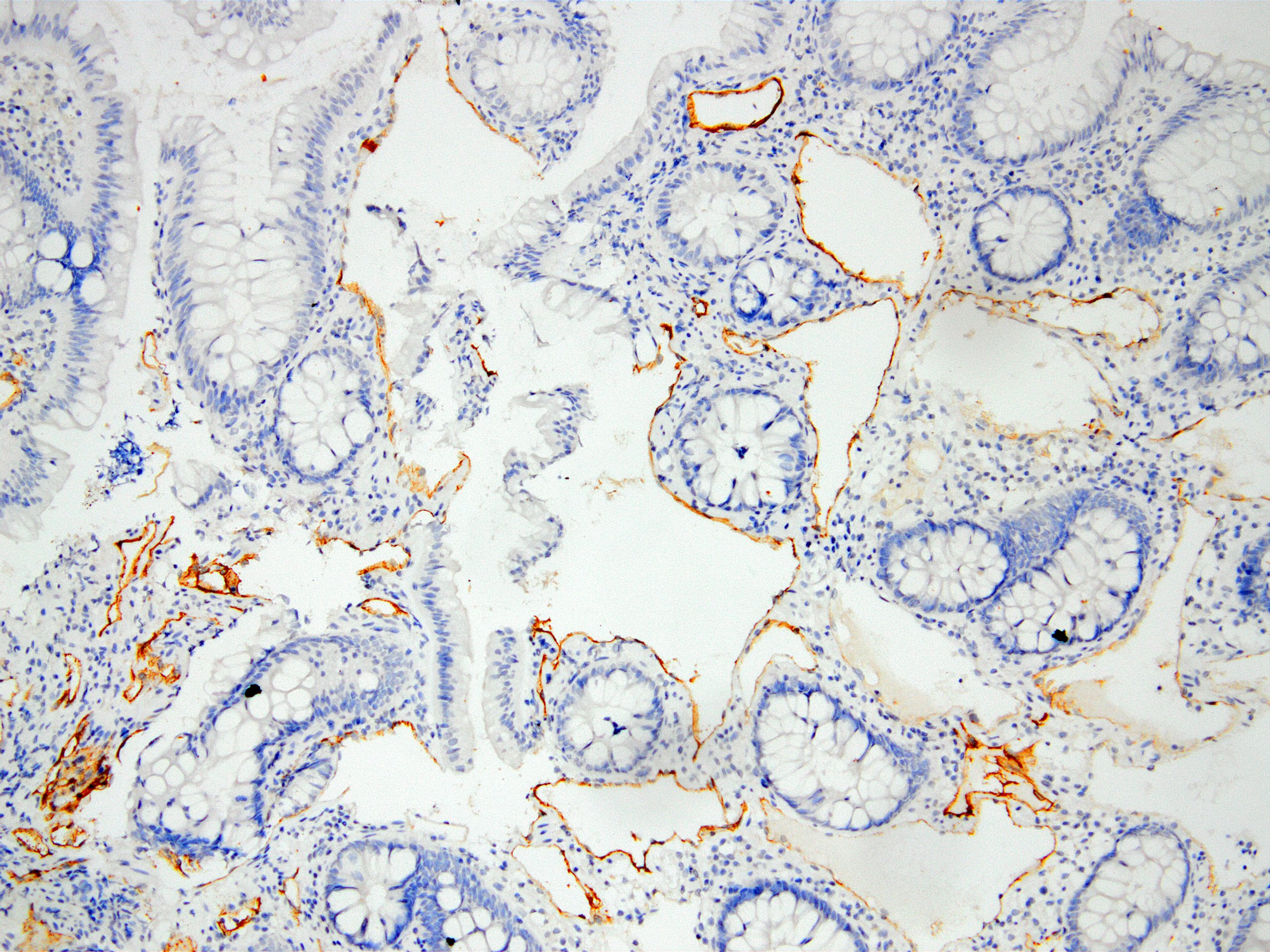 D2-40 in cecal lymphangioma 